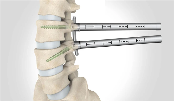 Minimally Invasive Spine Fixation System