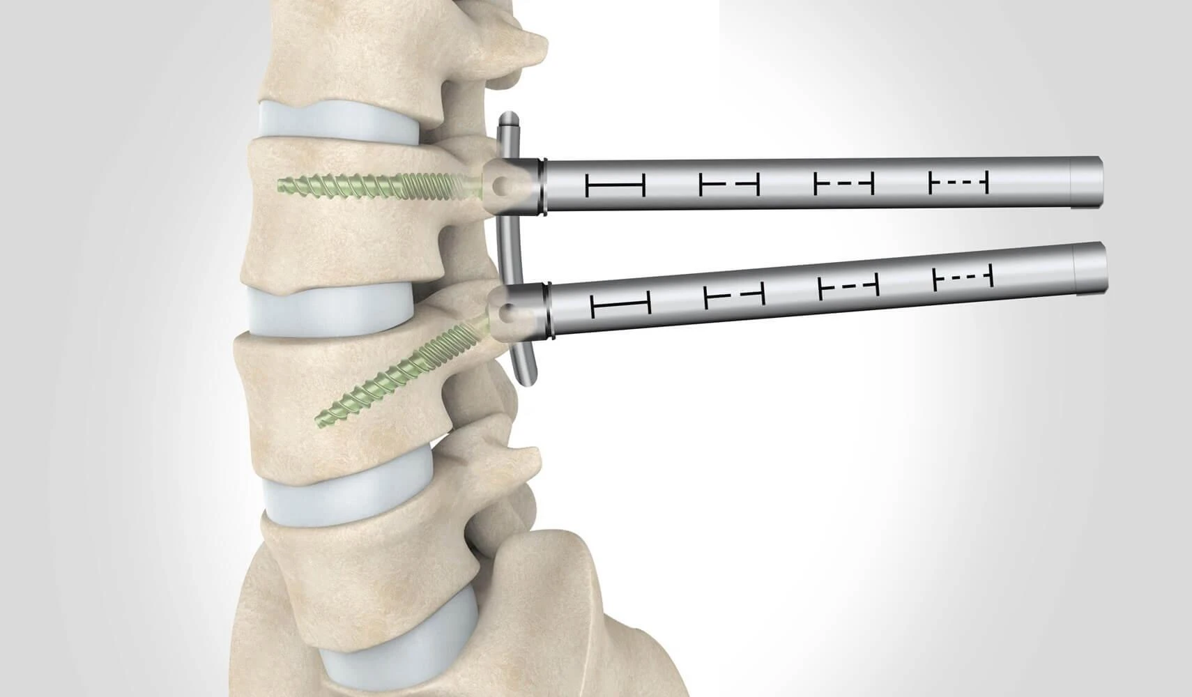 Minimally Invasive Spine Fixation System